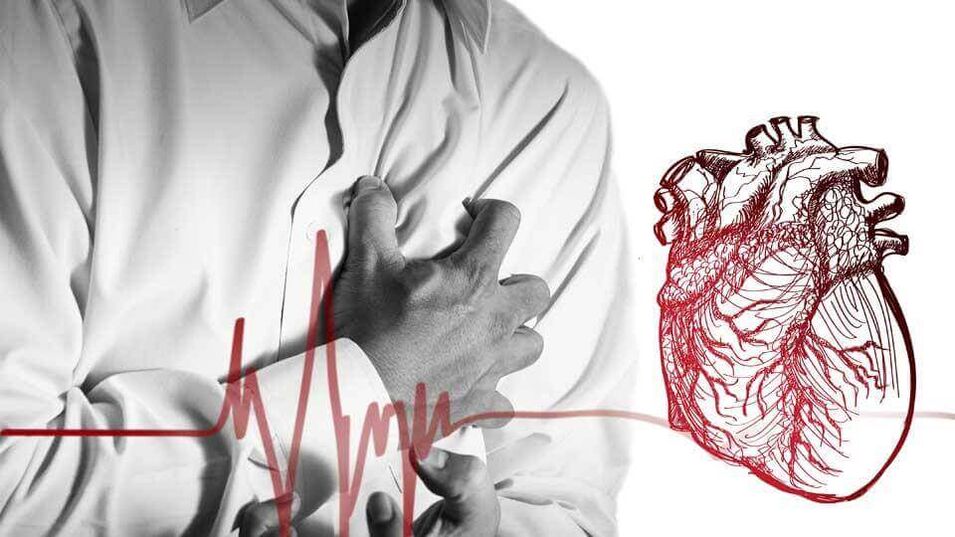 Dėl sutrikusio širdies ritmo sergant krūtinės ląstos osteochondroze gali išsivystyti ekstrasistolija