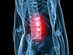Juosmens stuburo osteochondrozė