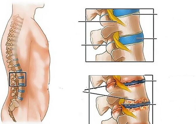 Juosmens srities osteochondrozė