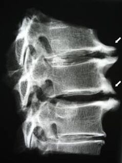 Gimdos kaklelio stuburo osteofitai sukelia kaklo skausmą