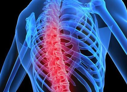 krūtinės ląstos stuburo osteochondrozė