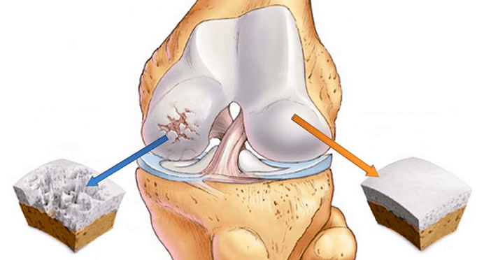 sveikos ir artrozės pažeistos kremzlės