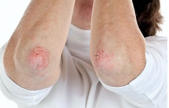 Žmonės, sergantys psoriaze, yra jautrūs psoriaziniam artritui