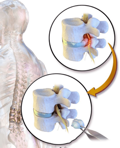 diskektomija nuo nugaros skausmo